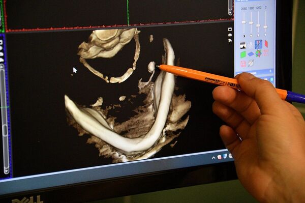 Почему камни появляются не только в почках, но и во рту - Sputnik Беларусь