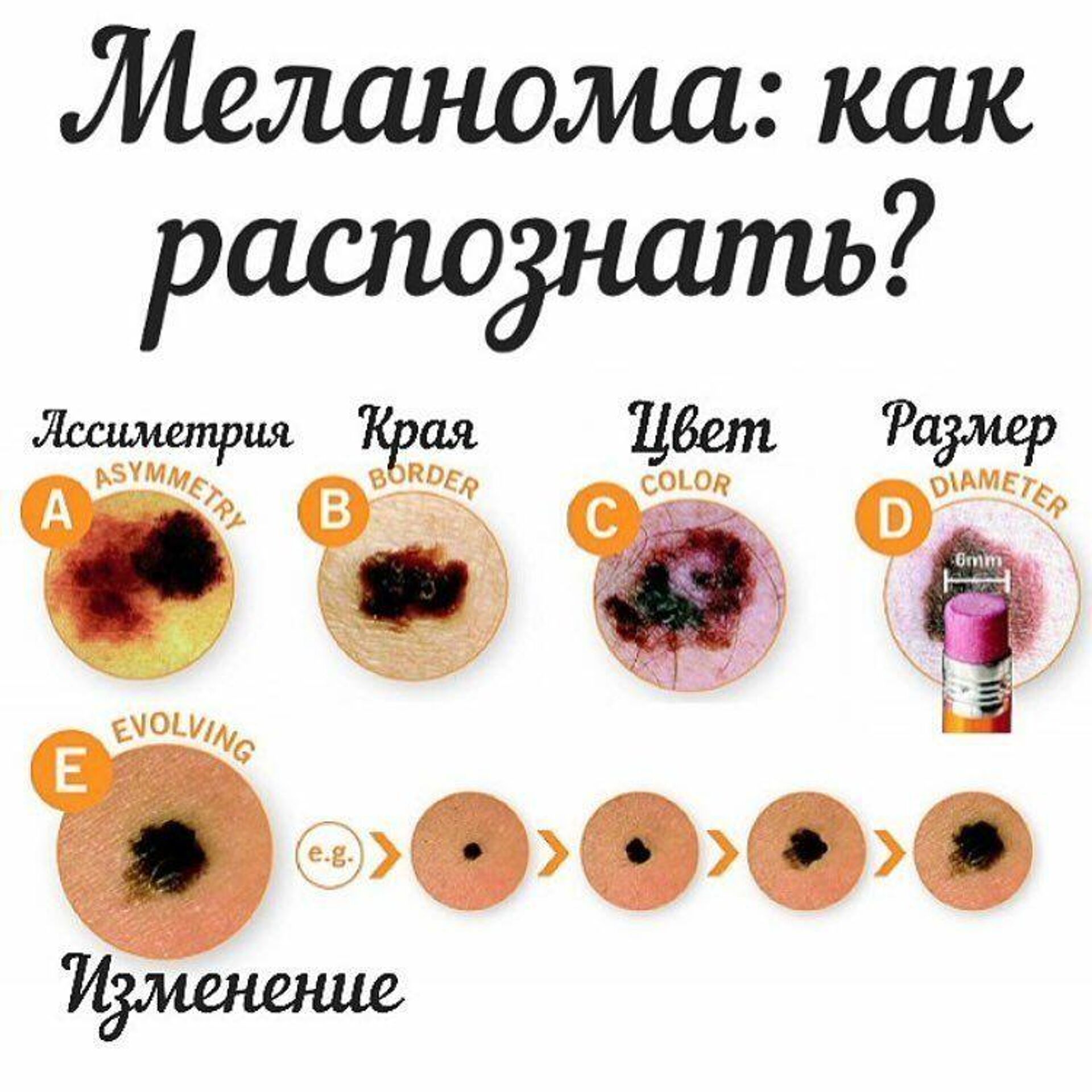 Рак кожи - Лечение опухолей кожи - Симптомы и диагностика - Киев