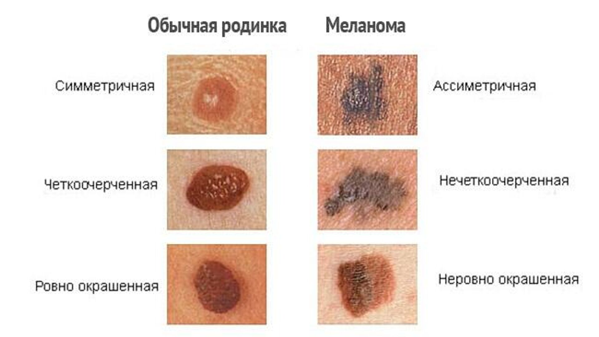 Зачем следить за родинками и как обнаружить меланому на ранней стадии?