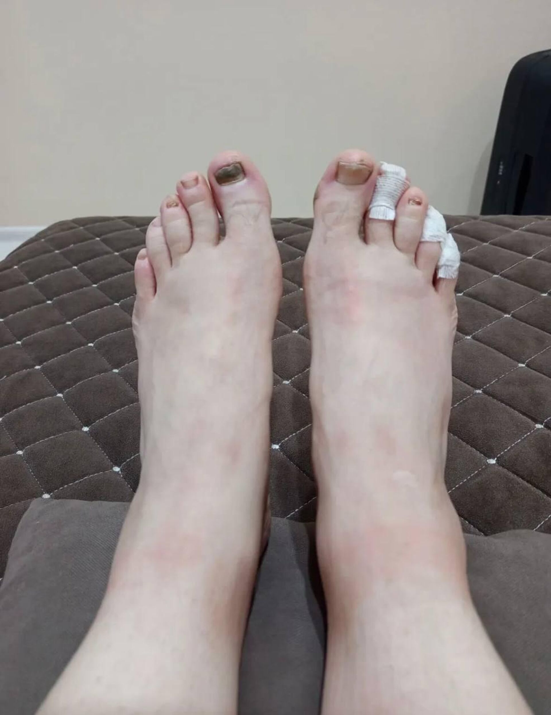 Так выглядели ноги Ольги Воробьевой после участия в шестисуточном ультрамарафоне в Москве - Sputnik Беларусь, 1920, 27.08.2025