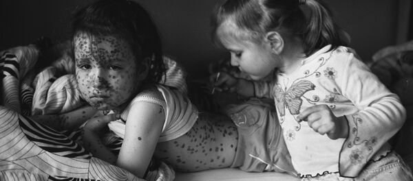 Вспышка ветрянки в московском детском саду - Sputnik Беларусь