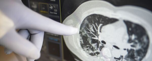 Лёгкія чалавека, хворага на каронавірус, архіўнае фота - Sputnik Беларусь